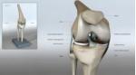 Types of Fracture Surgery and What to Expect Afterward